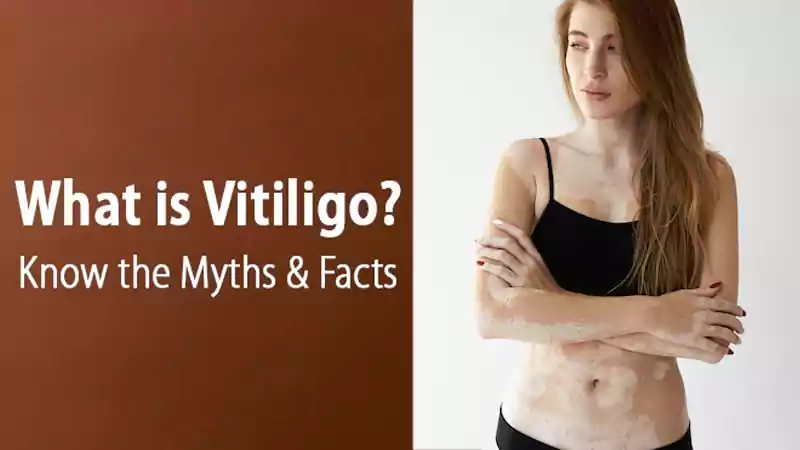Vitiligo Contagious